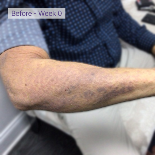 Arm before