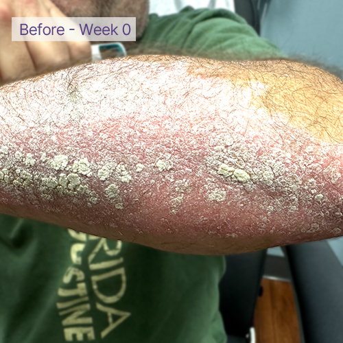 Arm before