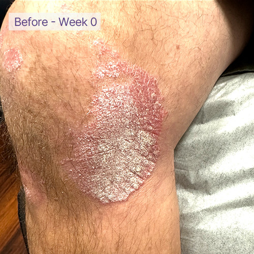 leg before