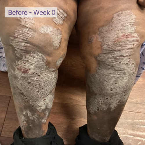 legs before