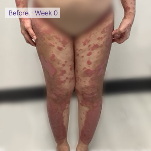 Legs before